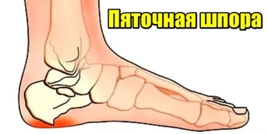 Пяточная шпора — шпора на пятке
